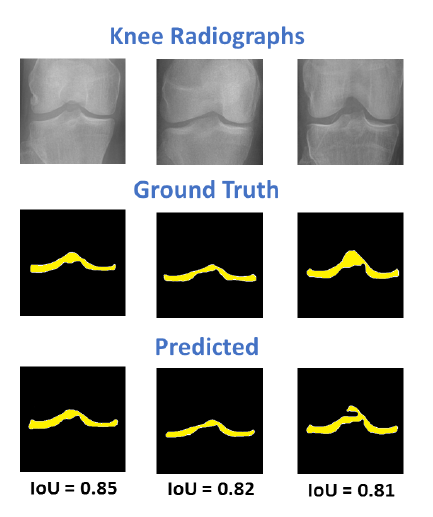 Give Me a Knee Radiograph, I Will Show You Where the Knee Joint Space Is: Enforcing Few-Sample Learning for Knee Semantic Segmentation