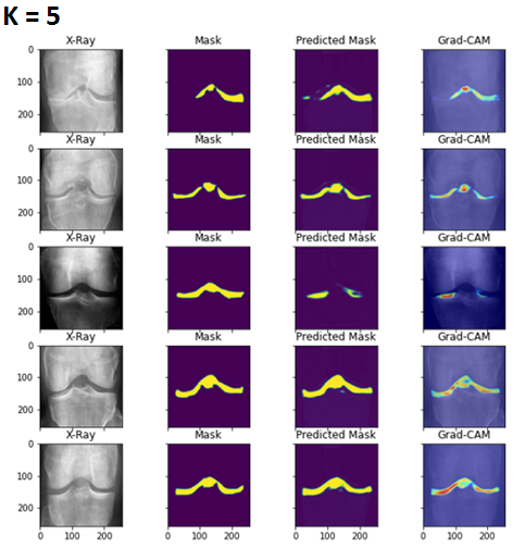 Enforcing Explainable Deep Few-Shot Learning to Analyze Plain Knee Radiographs